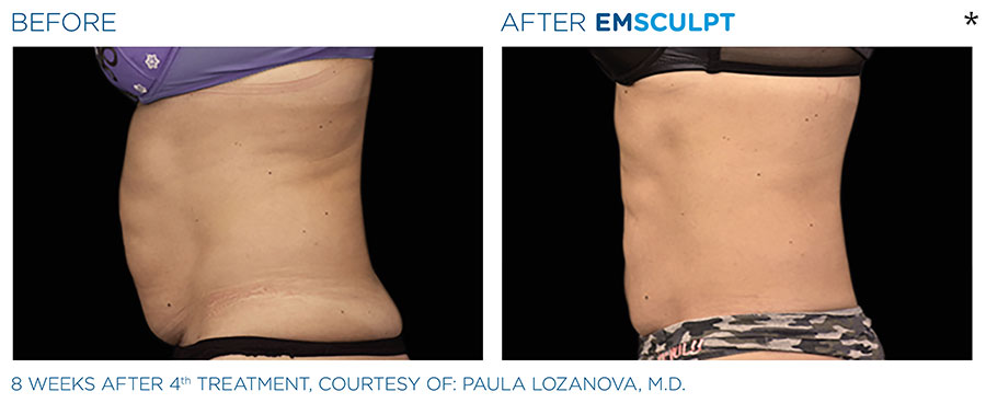 Before and After Photo of abdomen scultping Treatment in San Francisco